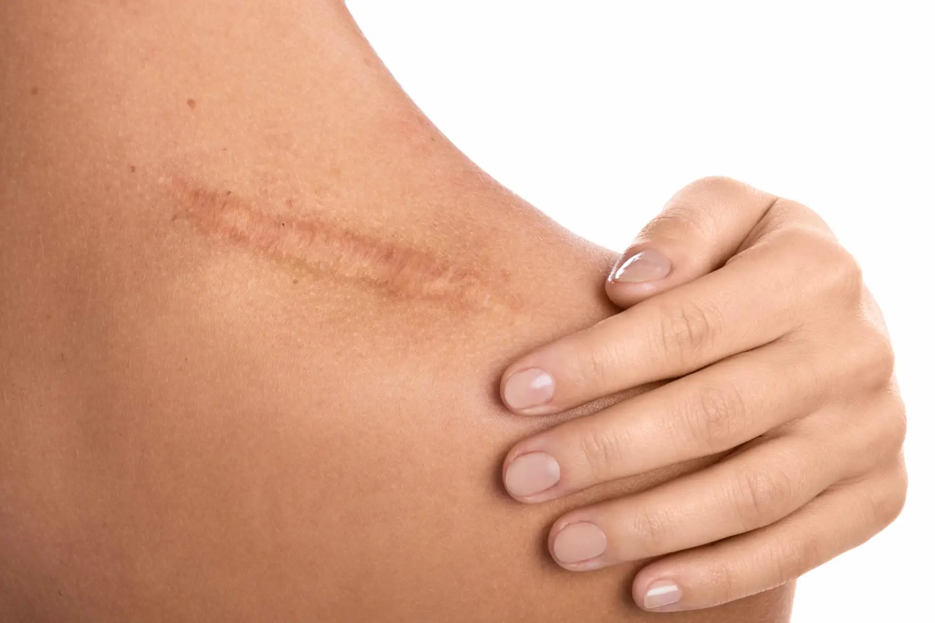 Close-up of a healed scar on the shoulder